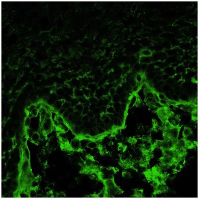 Diagnostic and prognostic values of conjunctival and oral biopsies analyzed by direct immunofluorescence in patients with mucous membrane pemphigoid